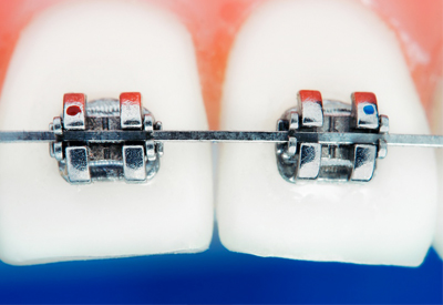 pdm_orthodontics-braces